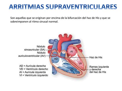 arritmias ventriculares y supraventriculares